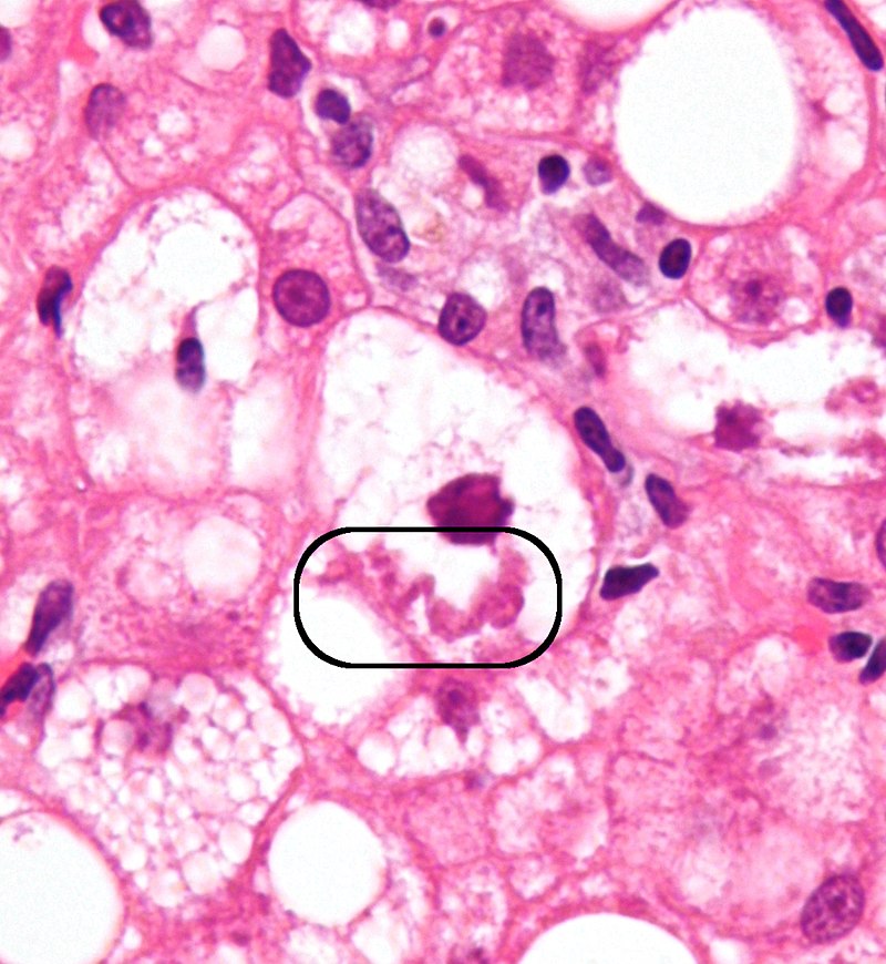 Nonalcoholic Fatty Liver Disease