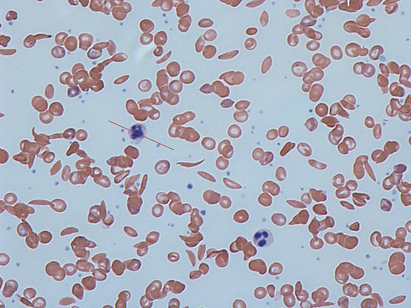 Sickle Cell Anemia