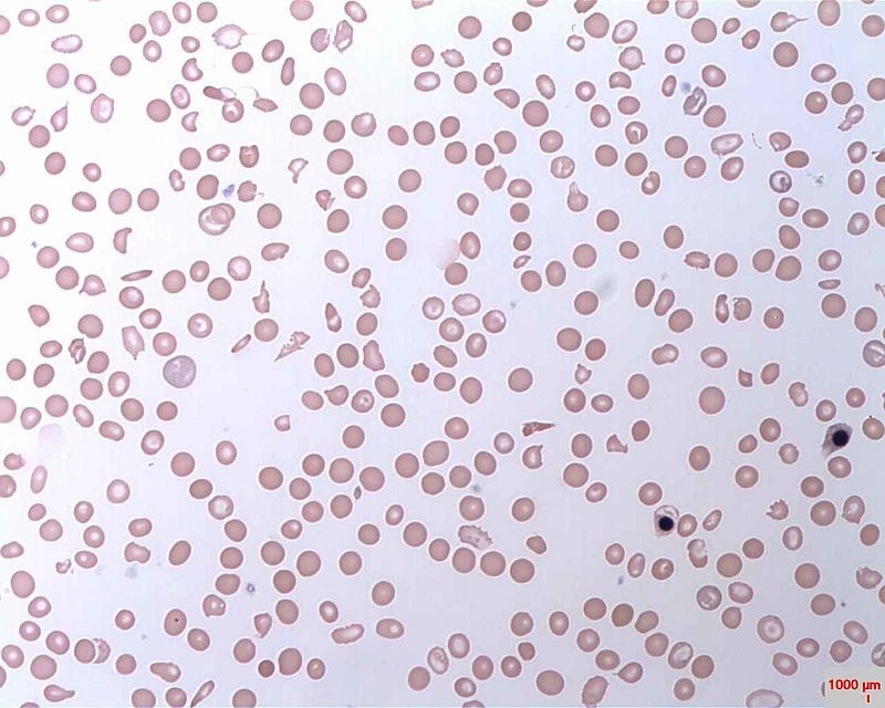 Paroxysmal Nocturnal Hemoglobinuria
