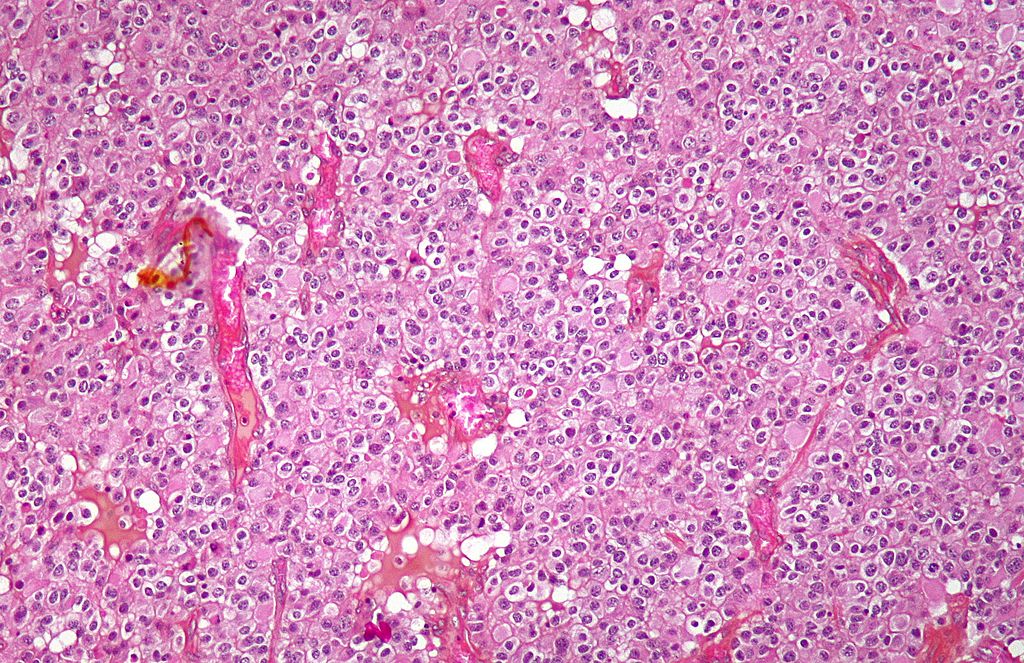 Oligodendroglioma