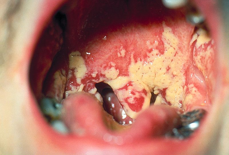 Oral Candidiasis