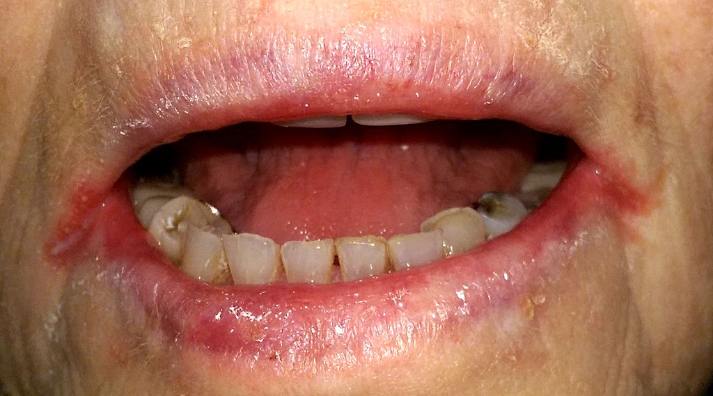 Oral Candidiasis