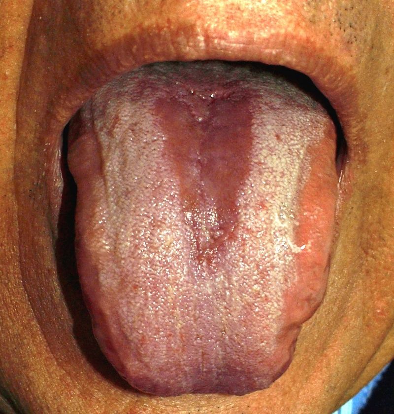 Oral Candidiasis