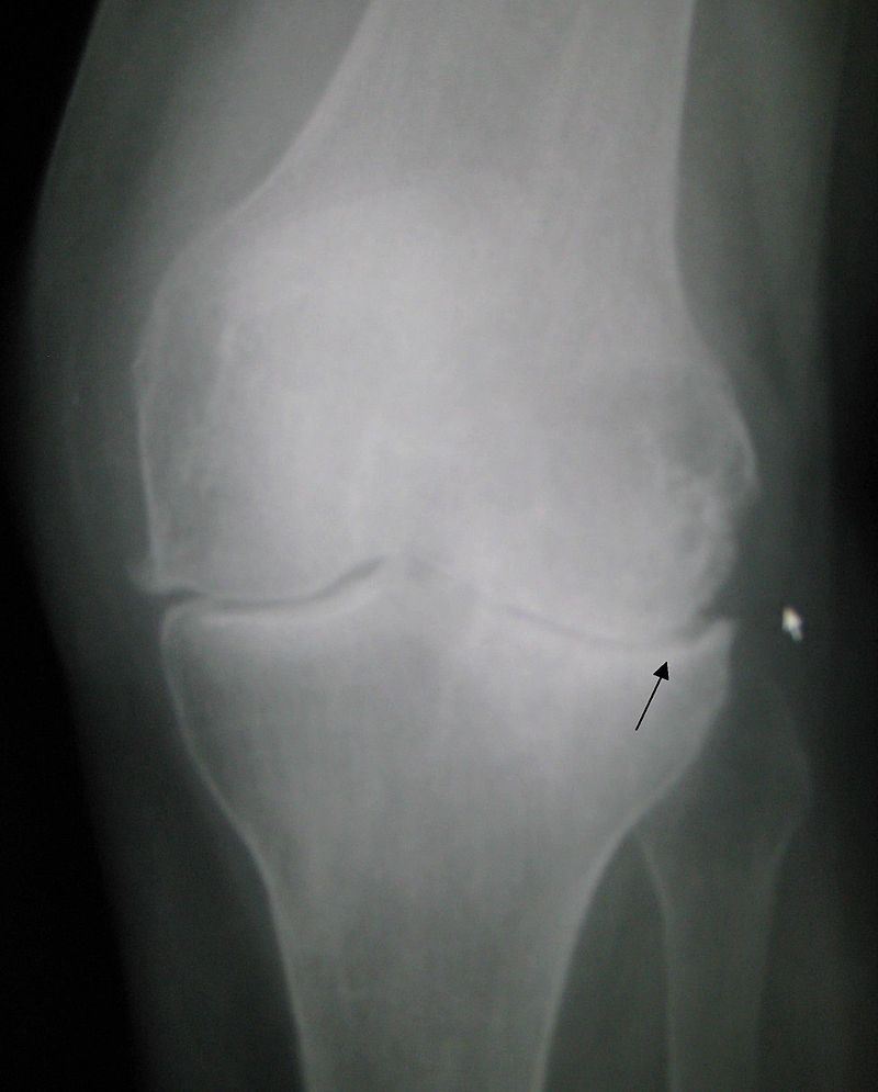 Osteoarthritis