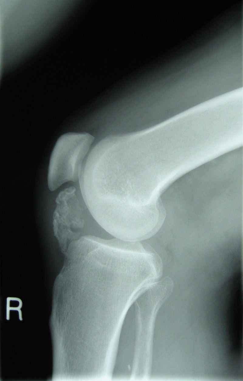 Osteochondroma