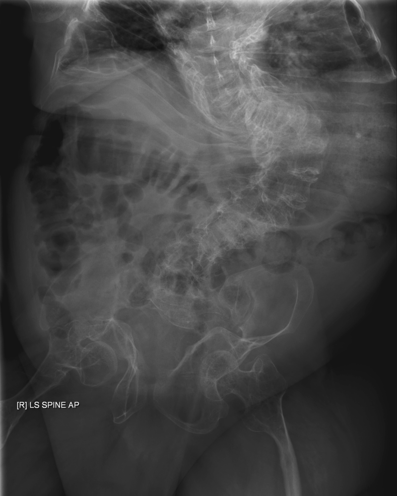 Osteogenesis Imperfecta