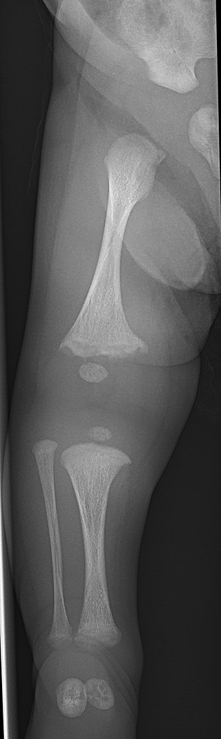 Osteogenesis Imperfecta