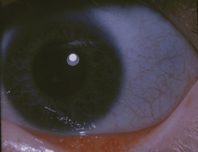 Osteogenesis Imperfecta