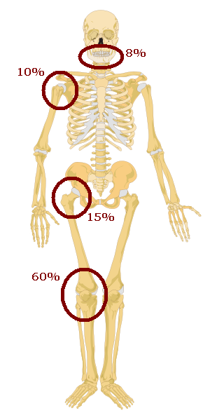 Osteosarcoma