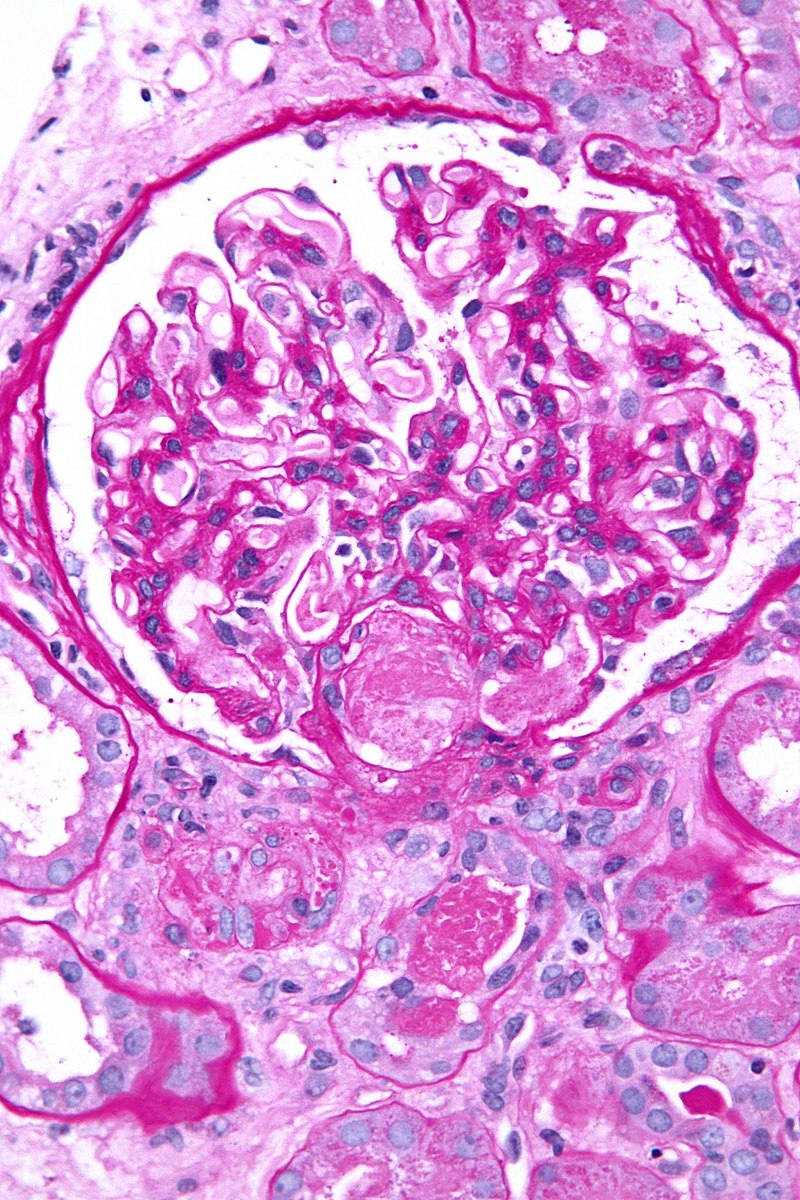Other Disorders of Hemostasis