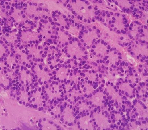 Pancreatic Carcinoma