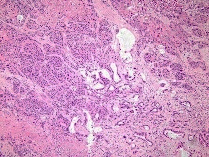 Pancreatic Carcinoma