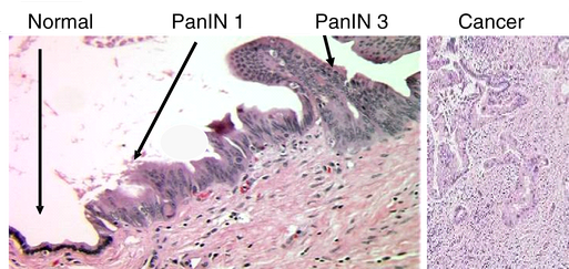Pancreatic Endocrine Neoplasms
