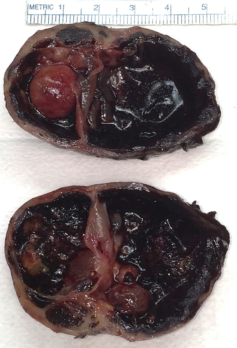 Papillary Thyroid Carcinoma