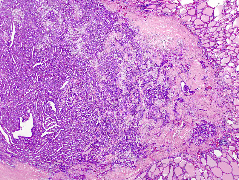 Papillary Thyroid Carcinoma