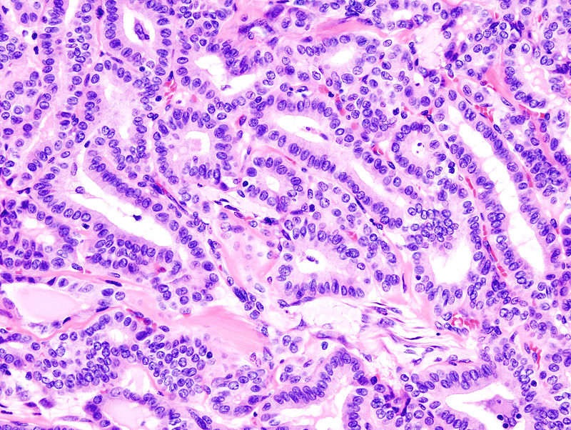 Papillary Thyroid Carcinoma