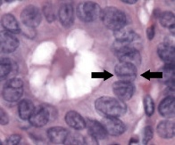 Papillary Thyroid Carcinoma