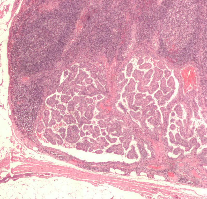 Papillary Thyroid Carcinoma