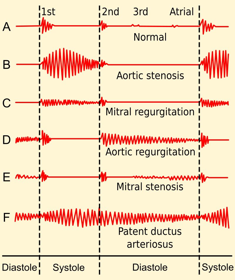 Patent Ductus Arteriosus