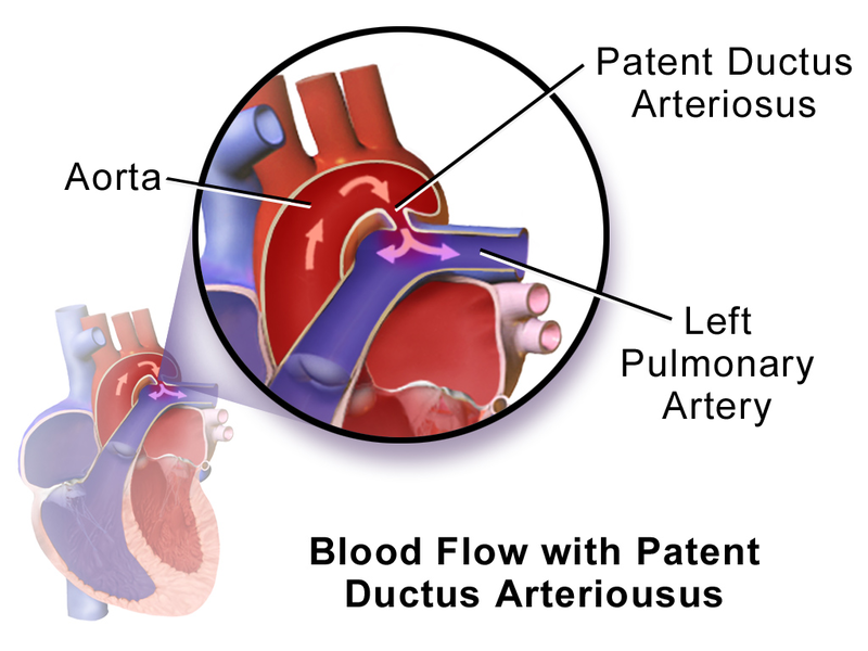 Patent Ductus Arteriosus