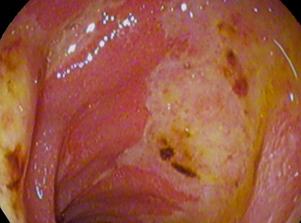 Peptic Ulcer Disease