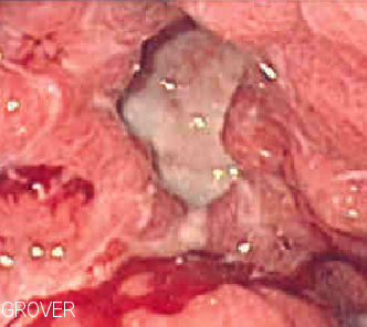 Peptic Ulcer Disease