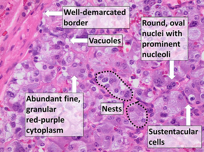 Pheochromocytoma