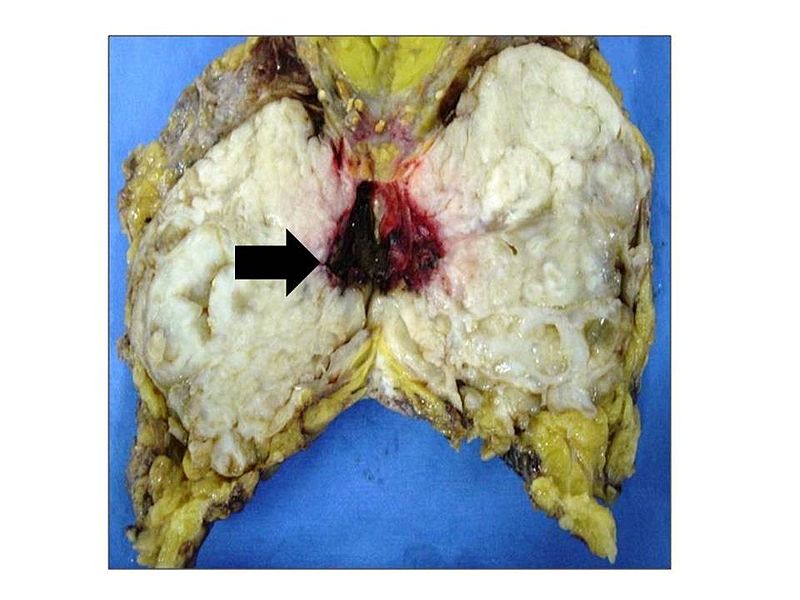 Phyllodes Tumor