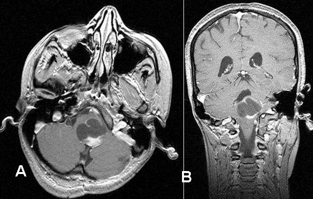 Pilocytic Astrocytoma