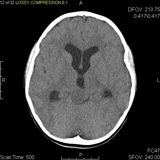 Pilocytic Astrocytoma