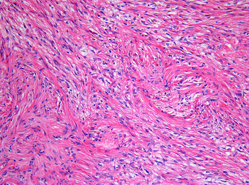 Pilocytic Astrocytoma
