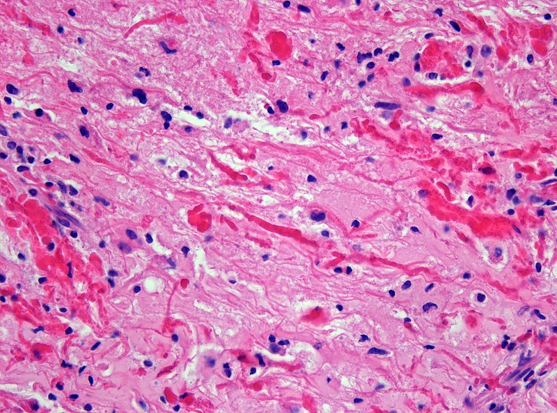 Pilocytic Astrocytoma