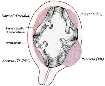 Placenta Accreta