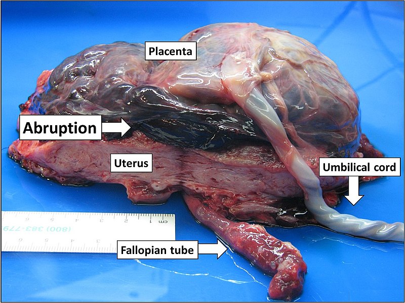 Placental Abruption
