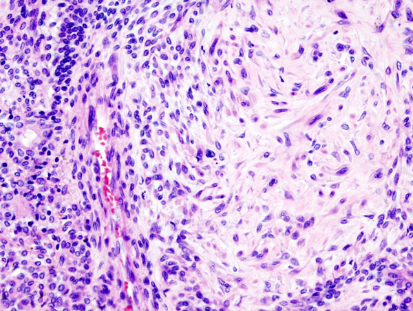 Pleomorphic Adenoma