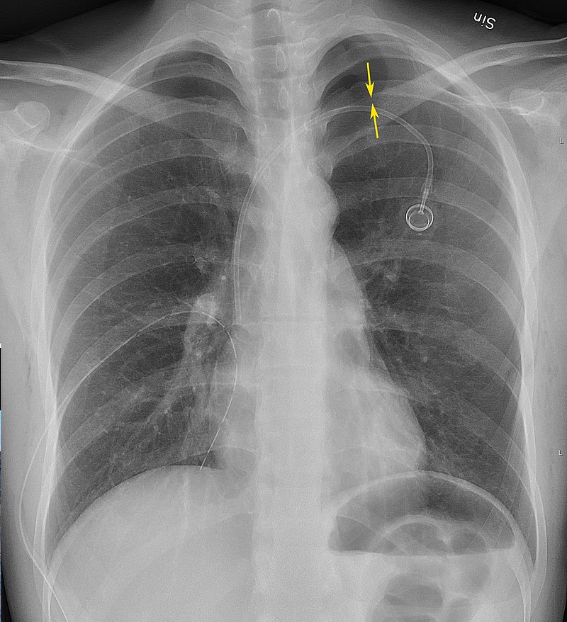 Pneumothorax