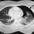 Pneumothorax