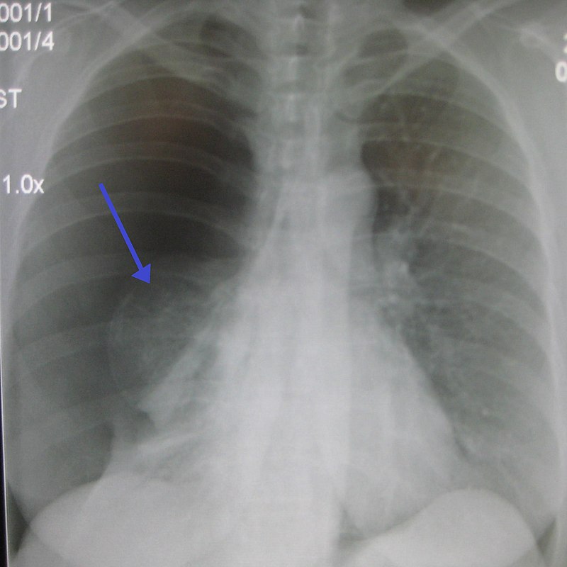 Pneumothorax