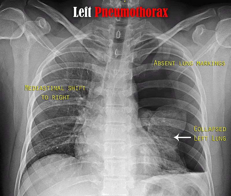 Pneumothorax