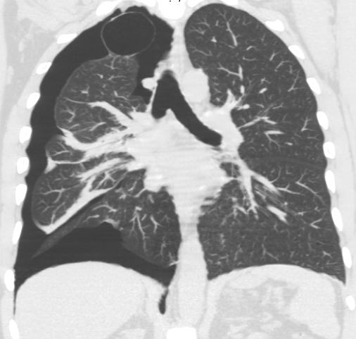 Pneumothorax