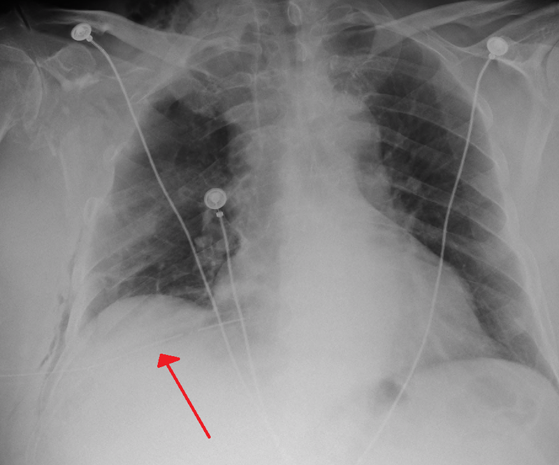 Pneumothorax