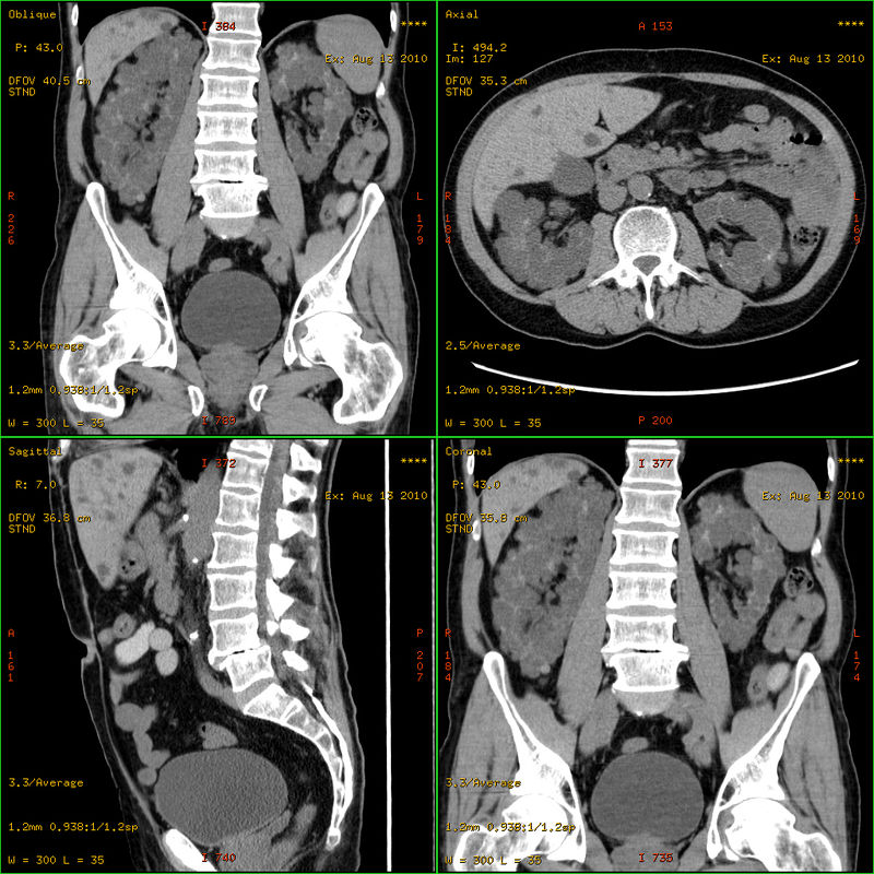 Polycystic Kidney Disease