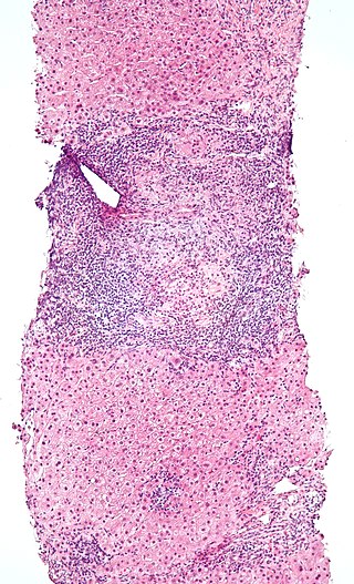 Primary Biliary Cirrhosis