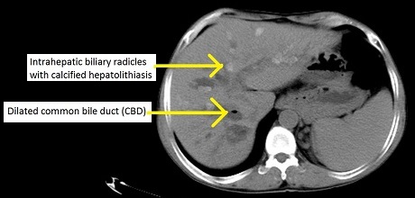 Primary Sclerosing Cholangitis