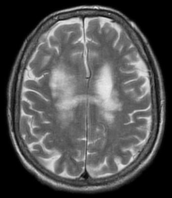 Progressive Multifocal Leukoencephalopathy