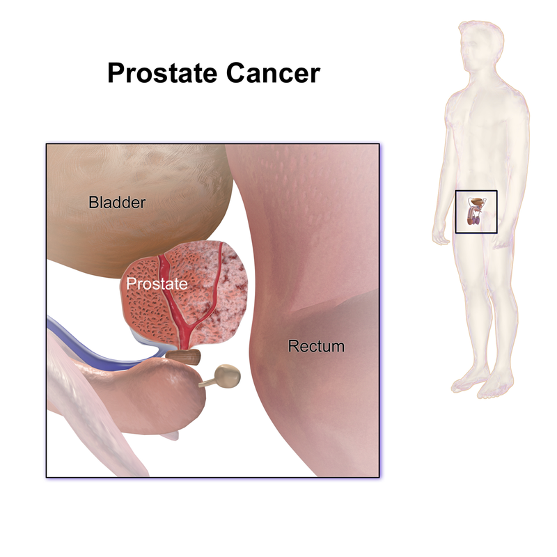 Prostate Adenocarcinoma