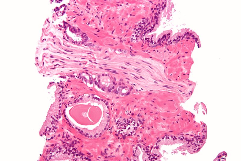 Prostate Adenocarcinoma