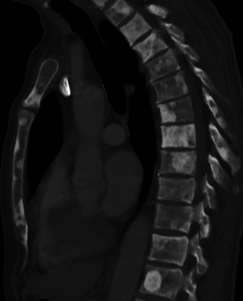 Prostate Adenocarcinoma