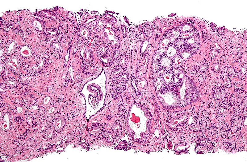 Prostate Adenocarcinoma