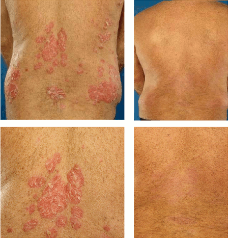 Psoriasis